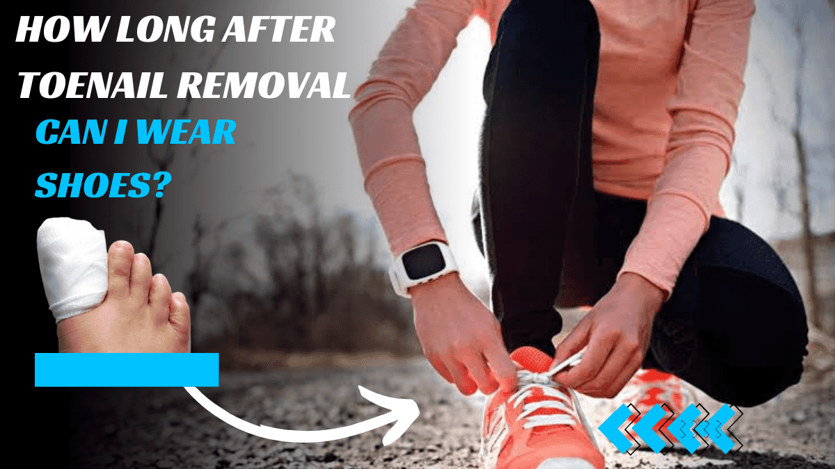 How Long After Toenail Removal Can I Wear Shoes