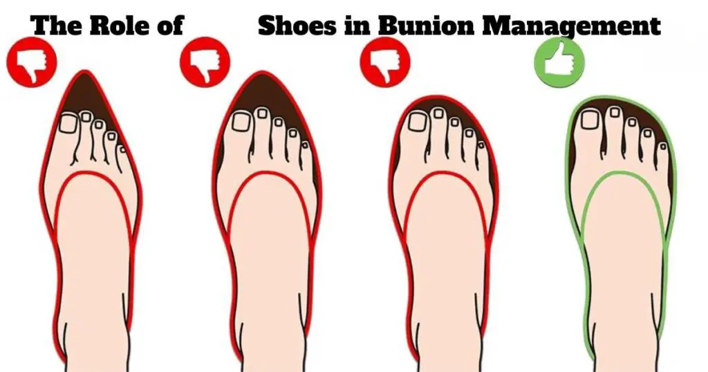 The Role of Shoes in Bunion Management