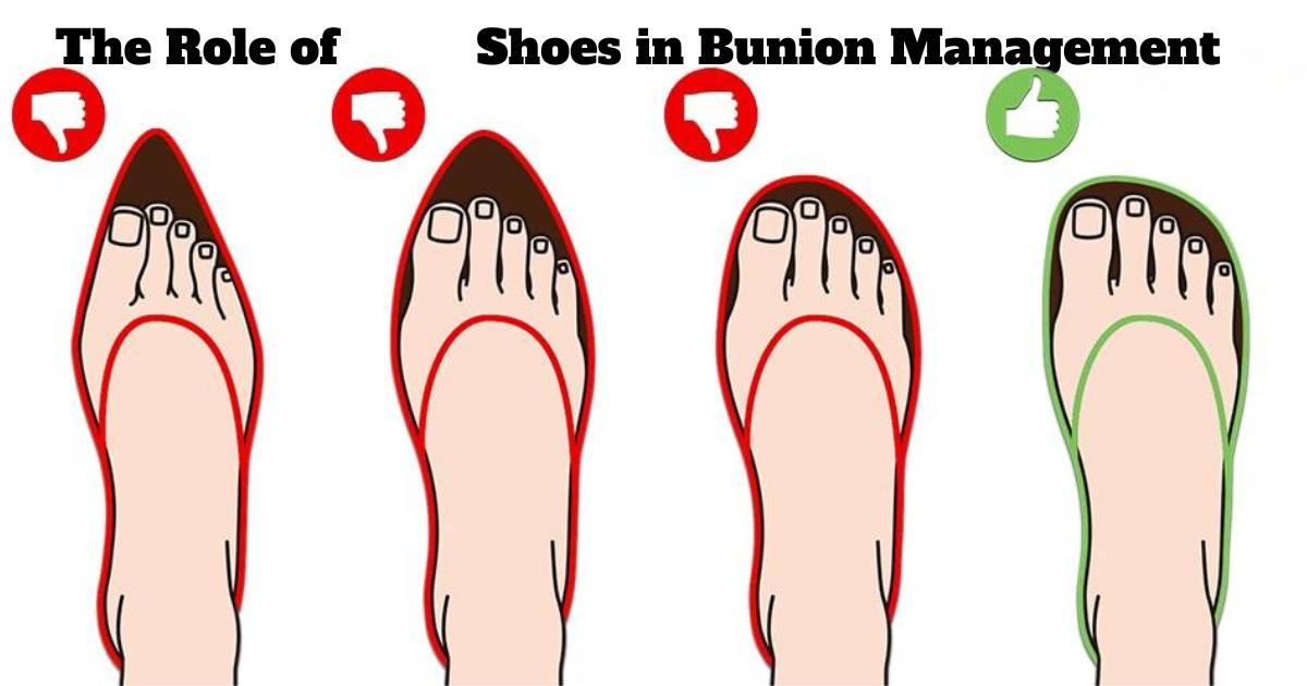 Do Orthopedic Shoes Help Bunions?